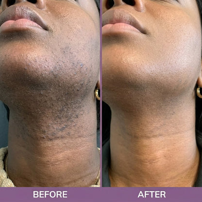 Cyperus Rotundus Oil for Hair Removal